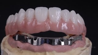 All on 4 implant bar supported denture [upl. by Aerb]