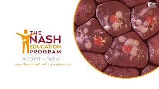 NASH liver disease progression in 3D from healthy liver to cirrhosis [upl. by Enniotna550]