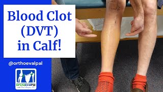 Blood Clot DVT in the Calf Actual Patient Presentation [upl. by Irved]