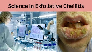 Exploring the Science of Exfoliative Cheilitis Unraveling the Mysteries [upl. by Emery]