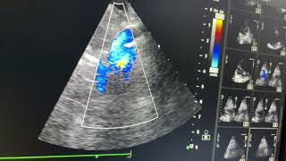 IVC type sinus Venosus ASD [upl. by Loseff]