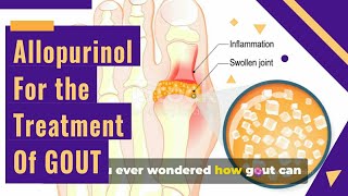 ALLOPURINOL Tablets ip 100mg AND GOUT Treatment [upl. by Eux701]