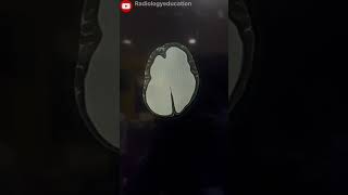 😱Hydrocephalus in brainshortsvideo radiology viral shortshorts hydrocephalus medicalmrict [upl. by Nnaycart188]