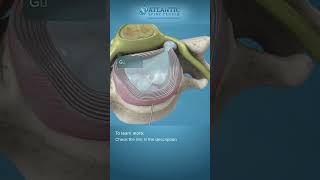 What is Endoscopic Anterior Cervical Discectomy shorts [upl. by Aicilev]