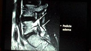 Spine Lecture Spondylolysis [upl. by Capello648]