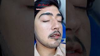 Carbon Peel Laser Treatment getsmarthairclub viralvideo beauty laserhairtreatment laser [upl. by Hoenack]