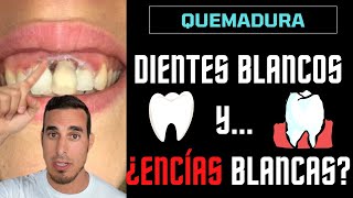 DIENTES BLANCOS y…¿ENCÍAS BLANCAS [upl. by Assilram]