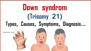 Down syndrome  Trisomy 21  Causes Symptoms Types Diagnosis [upl. by Ylyl]