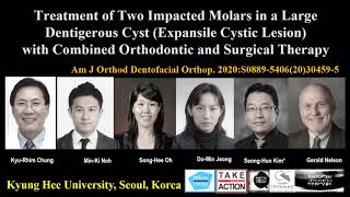 Treatment of 2 impacted molars in a large dentigerous cyst expansile cystic lesion with combined [upl. by Aronoel]