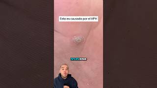 Esto no es un CALLO es VPH medicina Vph shorts [upl. by Zetnwahs]