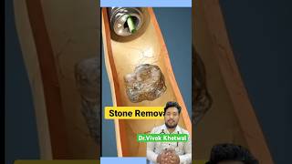 Endoscopic Lithotripsy l Dr Vivek Khetwal shorts stone [upl. by Eednac]