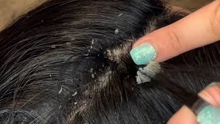 Picking and combing through dandruff psoriasis scalp scratching flare up [upl. by Anthia]