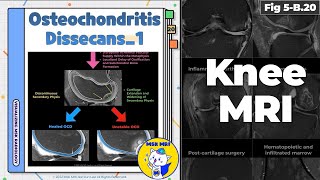 Fig 5B20 Pathogenesis of Osteochondritis Dissecans [upl. by Ahtivak127]