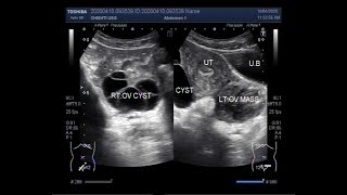 Ultrasound Video showing Two types of Ovarian Cysts and an Ovarian Mass [upl. by Lukasz]