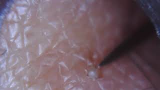 SEE WHAT COMES OUT Infected ingrown hair removed 1 of 2 [upl. by Akerboom]