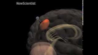 Fishing rod reels brain tumour cells to their death [upl. by Nitnelav]