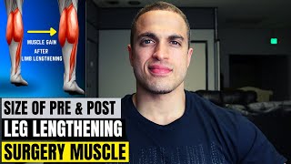 How Limb Lengthening Affects Muscle Sizeand vice versa [upl. by Kalmick]