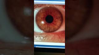 Severe contact lensrelated infectious keratitis scar Kanellopoulos MD [upl. by Ayatnohs723]