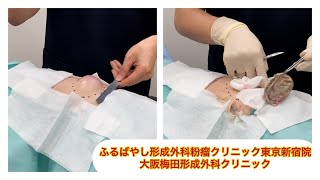 東京皮膚のできものと粉瘤クリニック ふるばやし形成外科新宿院 大阪梅田形成外科クリニック ブログでも詳しく解説してます。 大きな腰の粉瘤 切開法 [upl. by Entsirhc]