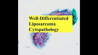 Lipomatous Tumor Cytopathology Interesting Case Conference [upl. by Levram]