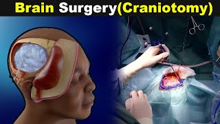 How Does Human Brain Surgery Works  Craniotomy Explained UrduHindi [upl. by Ney]