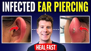 Doctor explains HOW TO RECOGNIZE AND TREAT INFECTED EAR PIERCING [upl. by Yreffeg443]