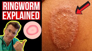 Doctor explains Ringworm aka Tinea including symptoms signs causes and treatment [upl. by Notffilc]