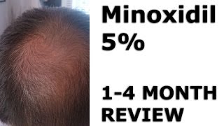 Minoxidil Hair Regrowth  Before amp After 14 Months [upl. by Eidualc]