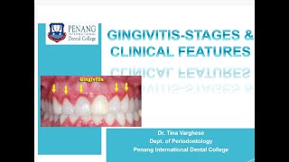 GINGIVITIS STAGES amp CLINICAL FEATURES [upl. by Anerbas]