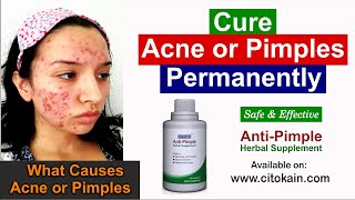 Whats Causes Acne or Pimples Pimples Treatment  Anti Pimples Medicine मुहांसों को करे जड से खत्म [upl. by Eenor]