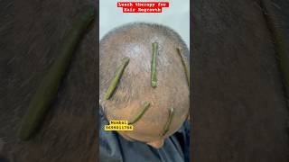 Which therapy is best for hair regrowth  LEECH THERAPY  shorts ytshorts hair kzhijama reels [upl. by Keram118]