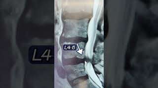 An Extruded Disc Herniation Case [upl. by Odla]