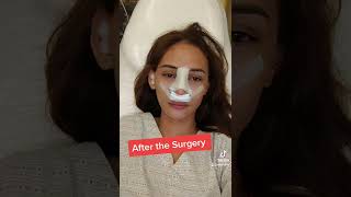 The day before rhinoplasty in the Philippines rhinoplasty philippines fypシ [upl. by Zilber]