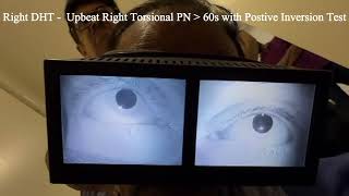 Right Posterior Semicircular Cupulolithiasis with Positive Inversion Test [upl. by Nellek]