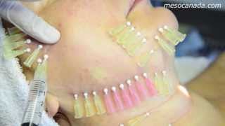 Thread Lifting 4D Mesotherapy [upl. by Asiela]