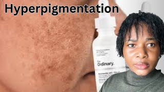 ULTIME GUIDE TRAITEMENT et Routine de Soins HYPERPIGMENTATION pour un TEINT CLAIRE sans TÂCHES [upl. by Eniawed]