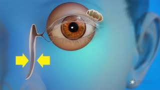 What is a blocked tear duct [upl. by Azile]