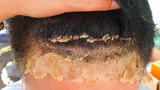 Flaky Dandruff Scratching Scalp Psoriasis 255 [upl. by Haletky363]