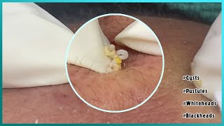 Big Cystic Acne Blackheads Extraction Blackheads amp Milia Whiteheads Removal Pimple Popping [upl. by Okomot898]