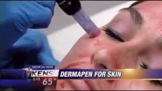 Platelet Rich Plasma PRP Demonstration with Dermapen® MicroNeedling Device [upl. by Elburt]