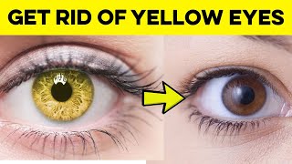 How to Get Rid of Yellow Eyes  Best Home Remedies for Yellow Eyes [upl. by Tesil]