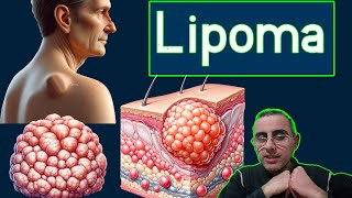 Lipoma  The most benign tumor [upl. by Scharff]