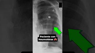 Cuál es el mejor modo ventilatorio para paciente con Neumotórax ⁉️🫁 emergency [upl. by Edroi]