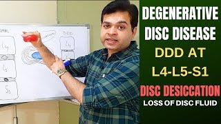 Degenerative Disc Disease DDD L4 L5 L5 S1Disc Desiccation Disc Degeneration Disease Treatment [upl. by Dewie]