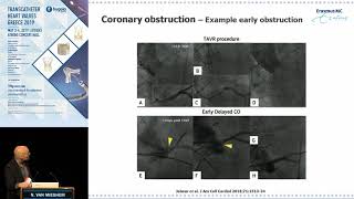 N Van Mieghem  Mechanisms of coronary obstruction during TAVR [upl. by Ahtimat]