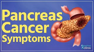 What are the symptoms of pancreas cancer [upl. by Seravart403]