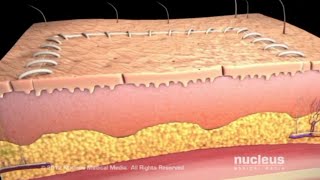 SKIN GRAFTING PLASTIC AND RECONSTRUCTIVE SURGERY [upl. by Lekym]