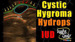 Cystic Hygroma  Hydrops Fetalis  Ultrasound  Anomaly  Case 214 [upl. by Padraic]