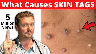 What SKIN TAGS Really Mean What Causes Skin Tags [upl. by Yle]