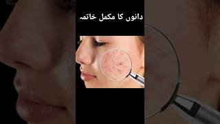 Pimples ampAcne solution ytshortstrendingviralbeautytipssimplebeautytipsdiy [upl. by Naicad127]